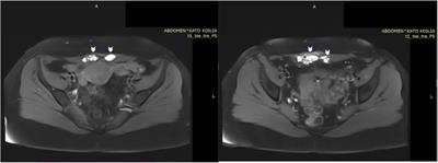 Surgical management of abdominal wall sheath and rectus abdominis muscle endometriosis: a case report and literature review